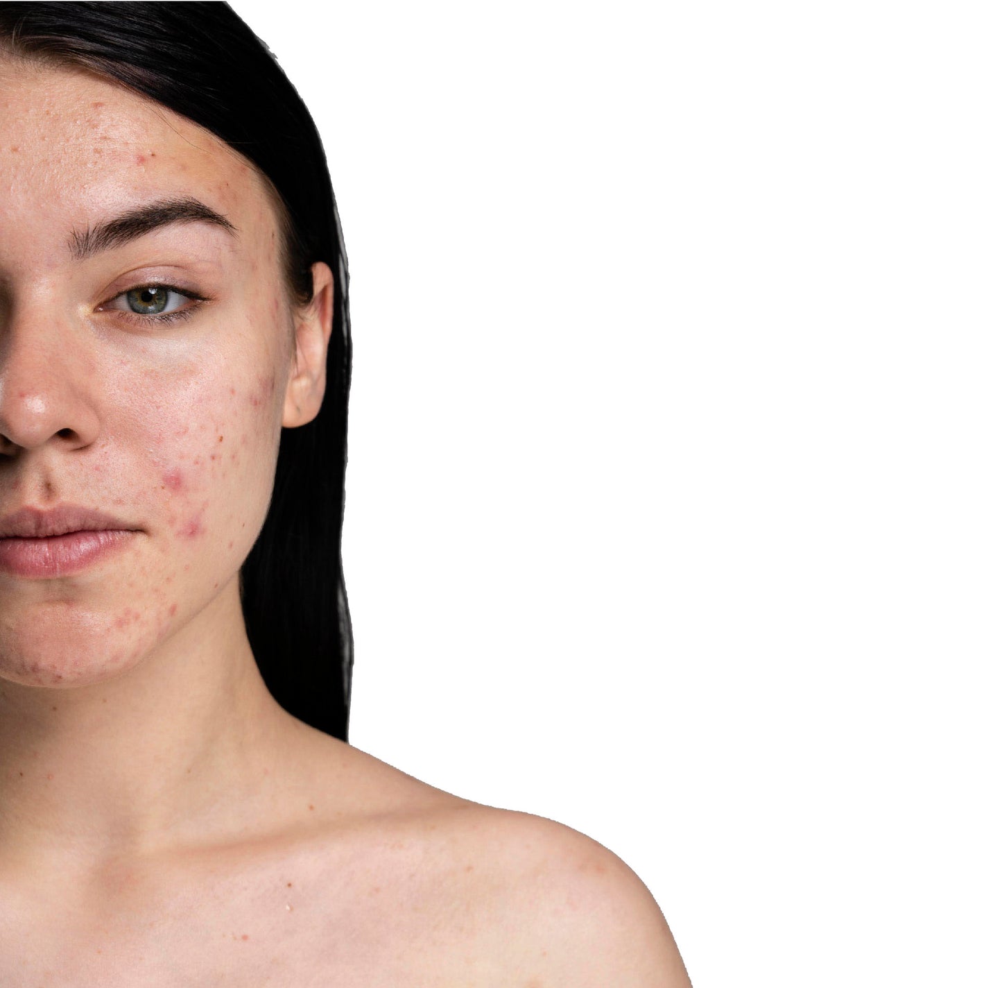 Facial especializado control de Acné