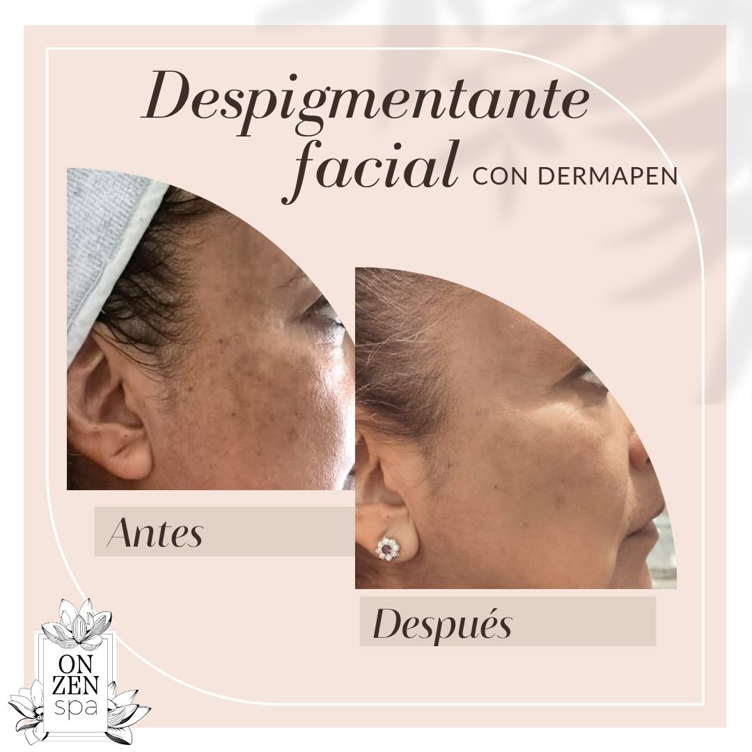 Facial especializado Despigmentante con Dermapen